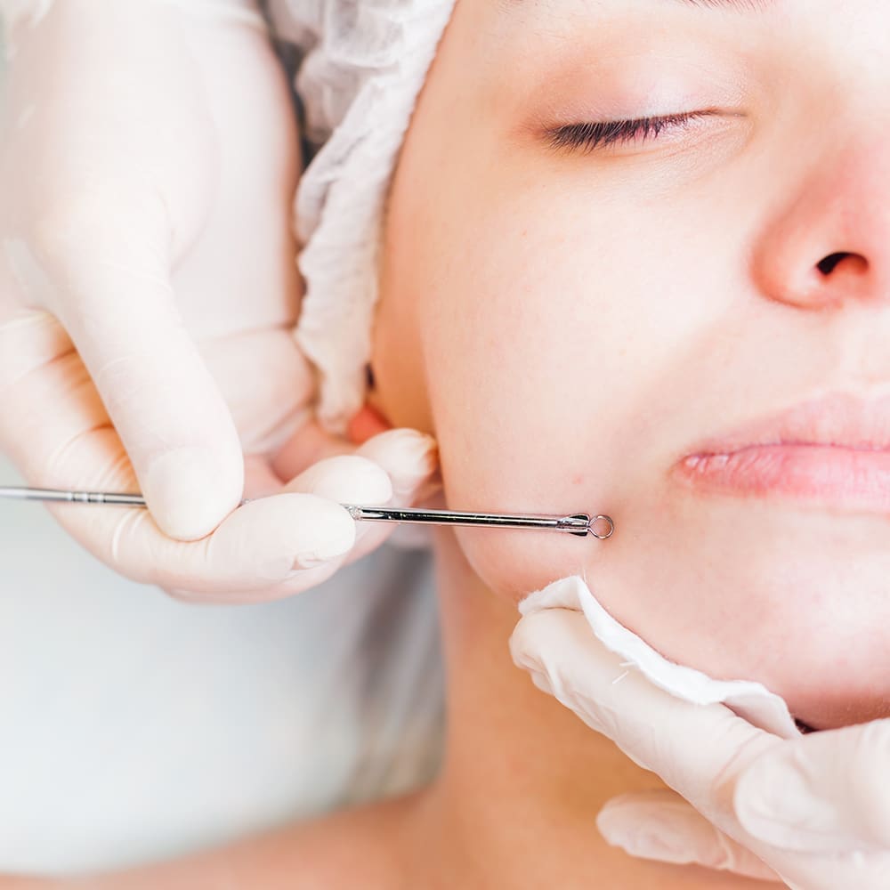 Was passiert bei einem Akne Cleansing?