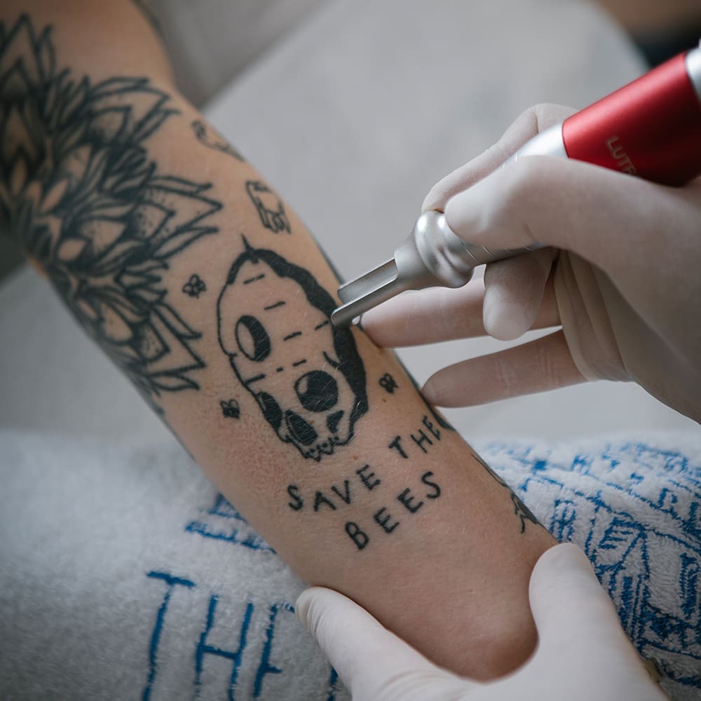 Pikosekundenlaser versus Nanosekundenlaser