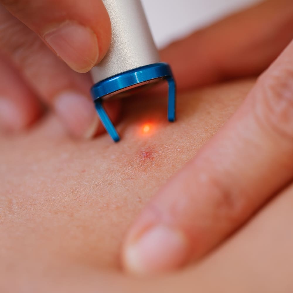 Was passiert bei einer IPL Behandlung gegen Rötungen?