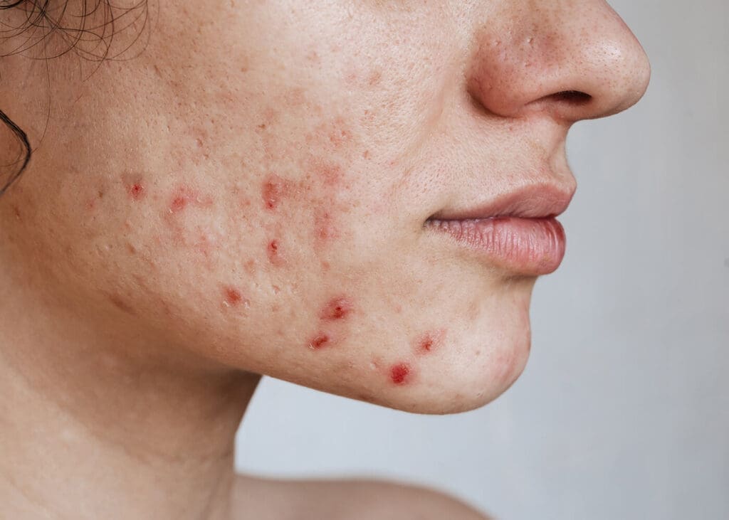 Akne: Diese Behandlungen könnten Abhilfe schaffen
