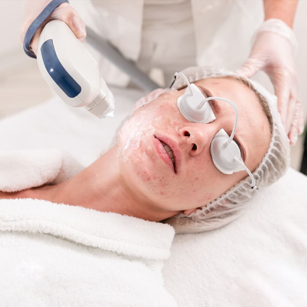 Akne Behandlung mit IPL Laser