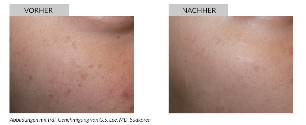 Tattooentfernung Vorher Nachher