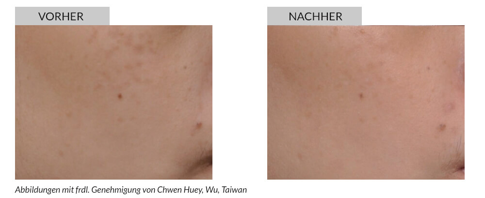 Tattooentfernung Vorher Nachher