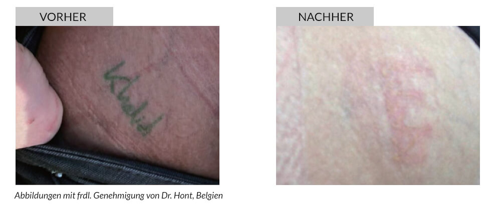 Tattooentfernung Vorher Nachher
