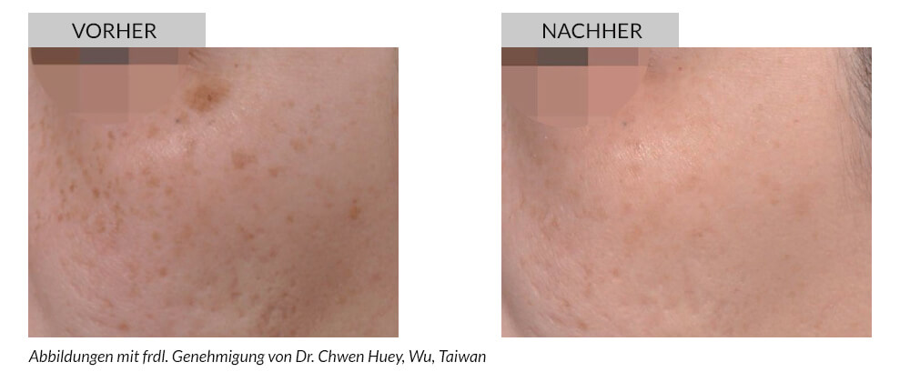 Tattooentfernung Vorher Nachher