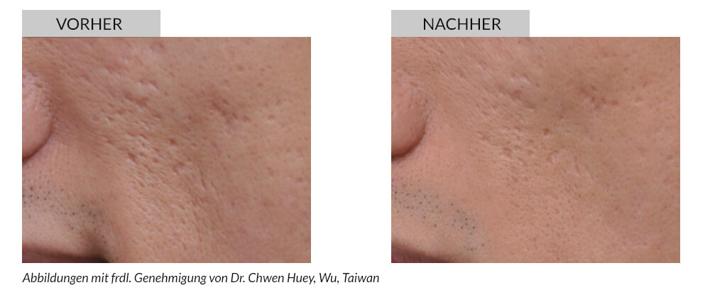 Tattooentfernung Vorher Nachher