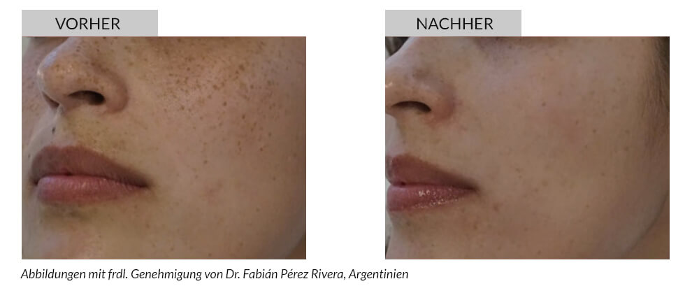 Tattooentfernung Vorher Nachher