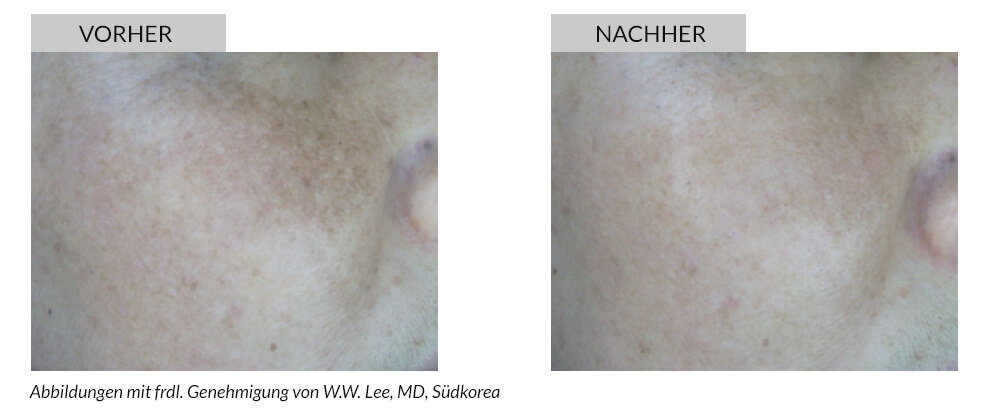 Tattooentfernung Vorher Nachher